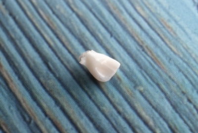 как выглядит молочный зуб